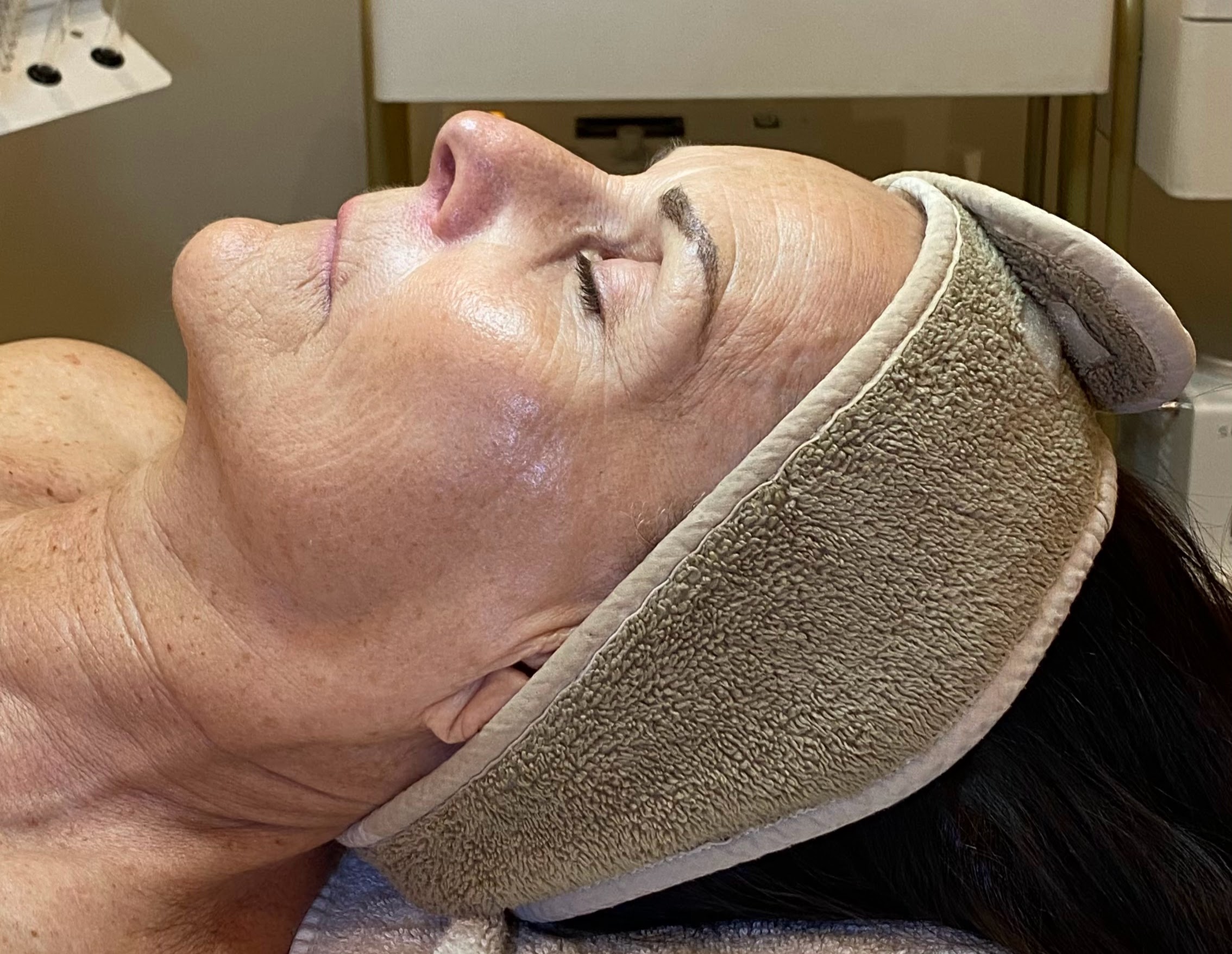 The same Iconic Skin client's skin after her facial treatment, showing clearer, smoother texture