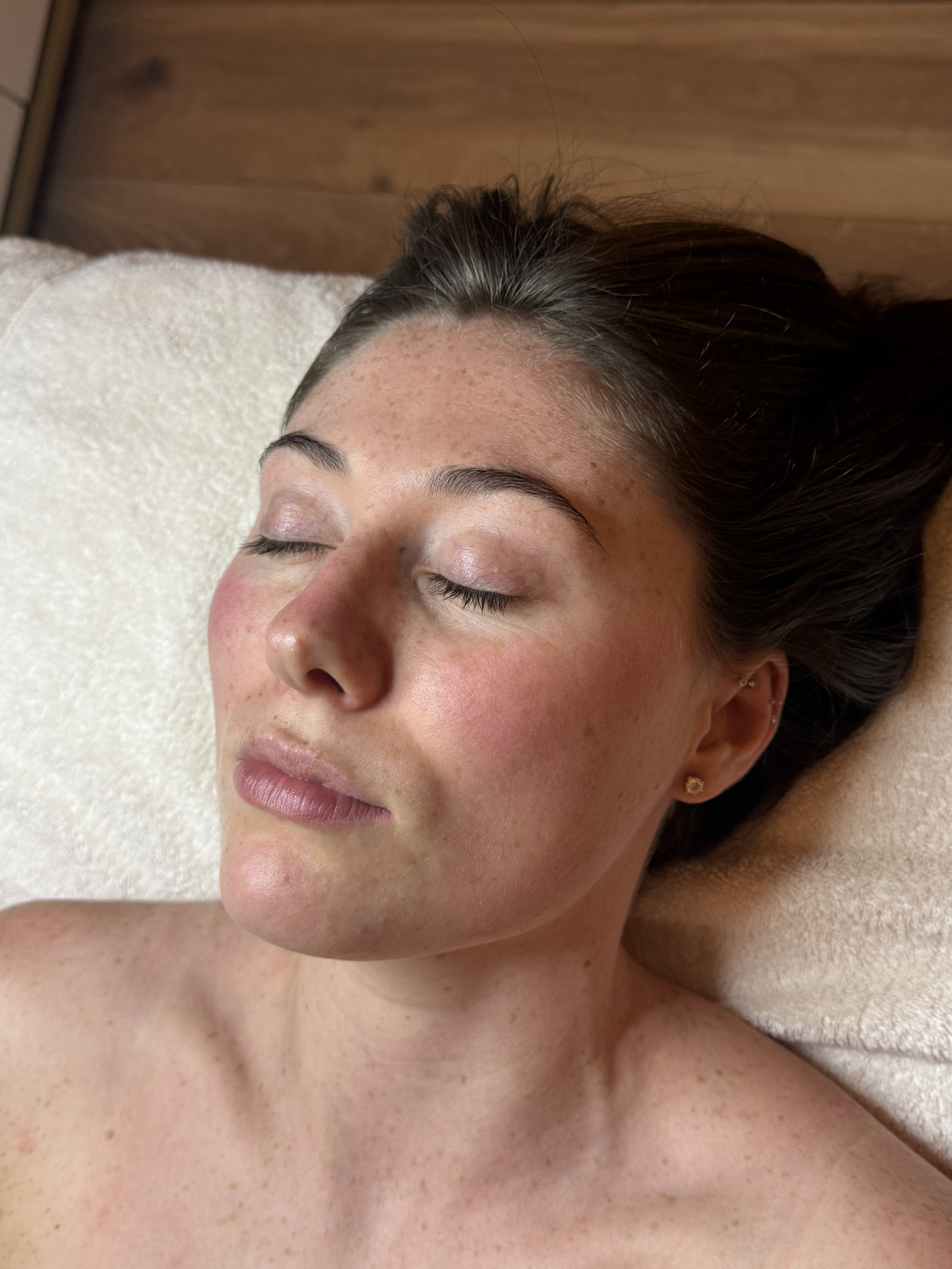 Iconic Skin client's skin before her advanced treatment, showing uneven texture and tone