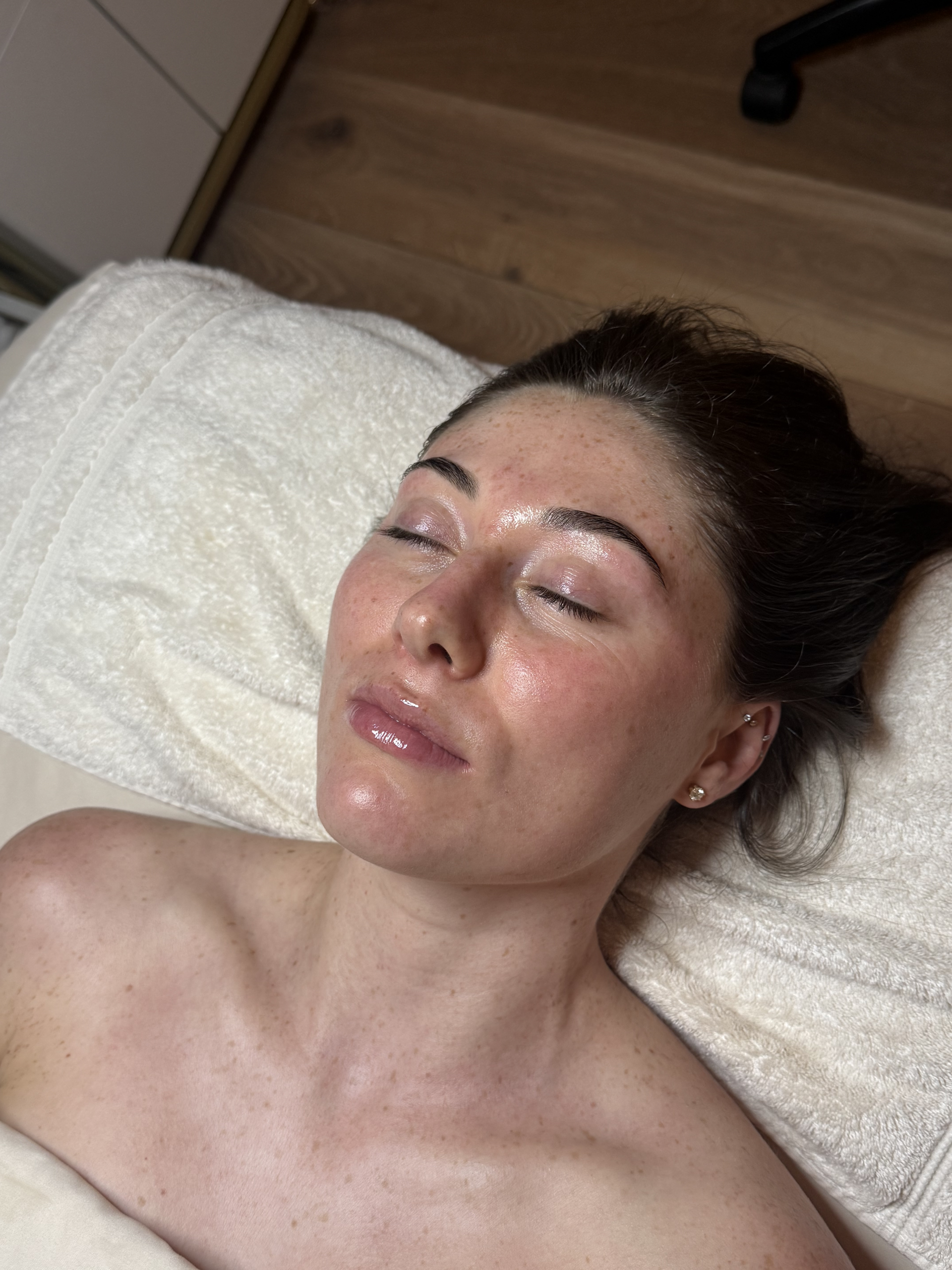 The same Iconic Skin client's skin after her advanced treatment, showing smoother, more even texture