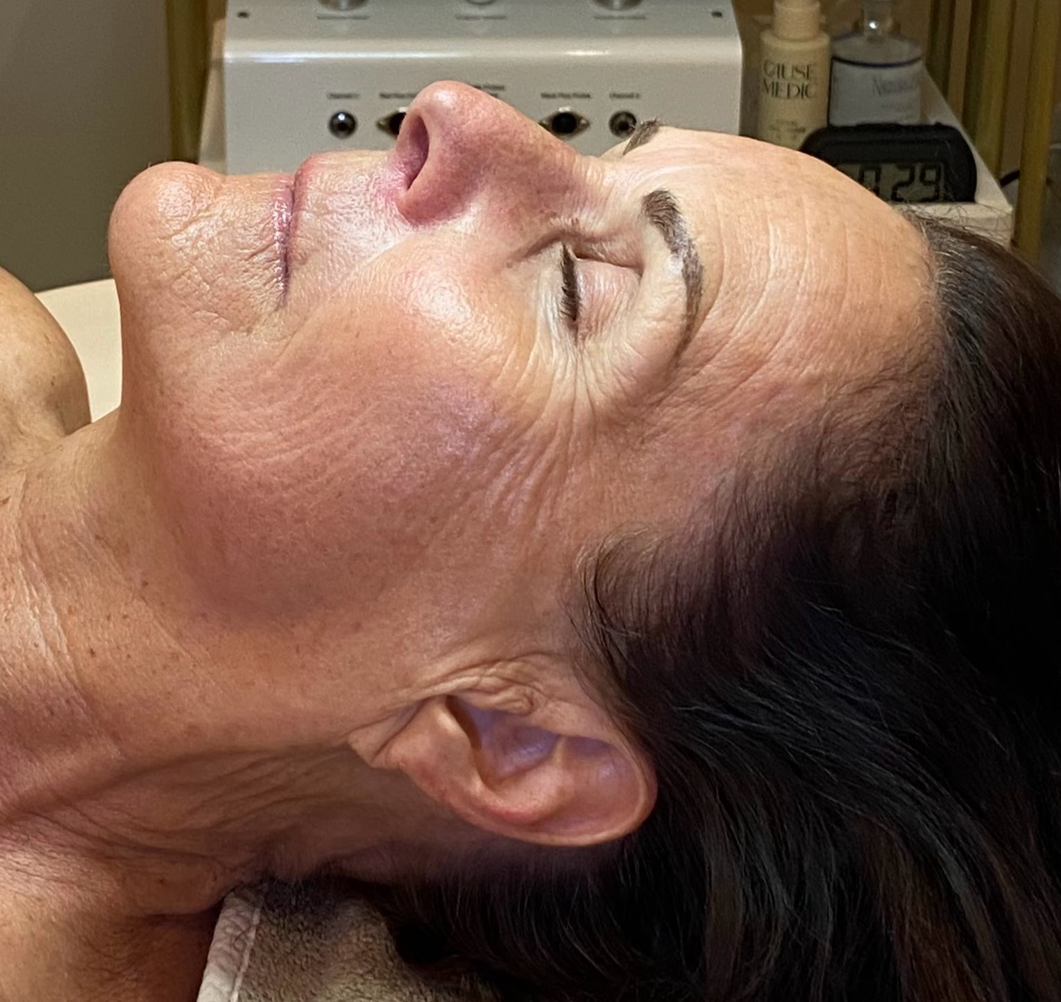 Iconic Skin client's skin before her facial treatment, showing congestion and uneven texture