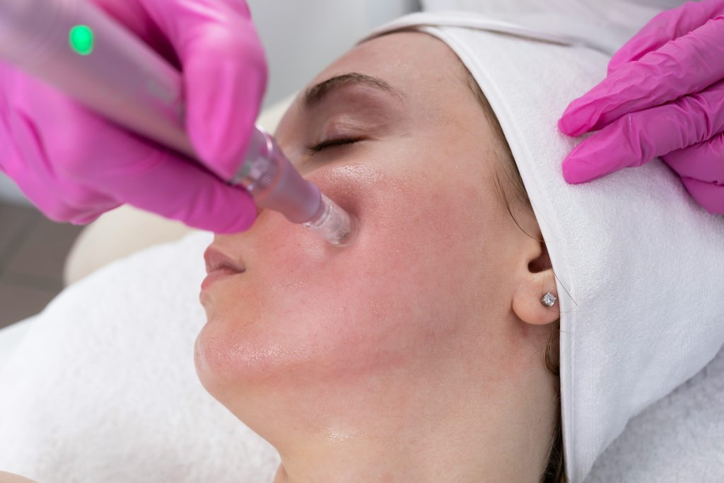 Microneedling treatment at Iconic Skin Boutique